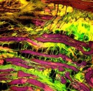 L’editing genomico contro la distrofia miotonica