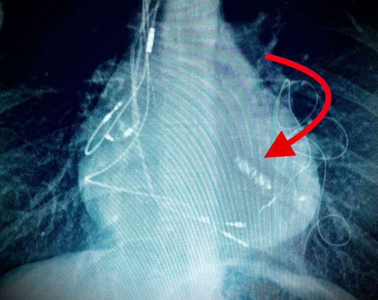 A Taormina impiantato per la prima volta in Italia pacemaker senza elettrodi