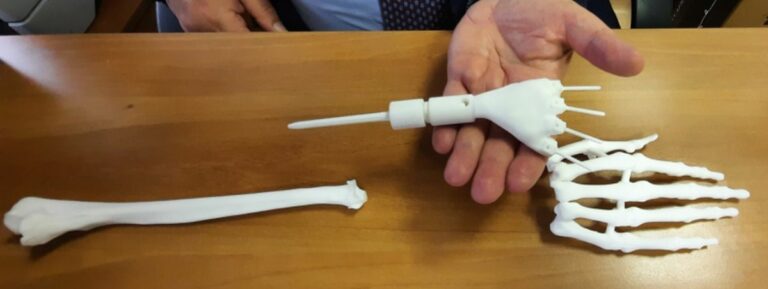 Polso realizzato con una stampante 3D salva la mano di una neo-mamma