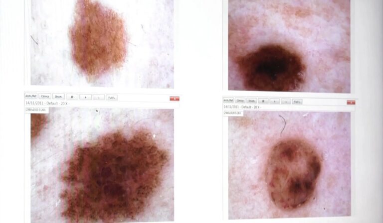 Melanomi e altri tumori della pelle, i consigli dell’esperto