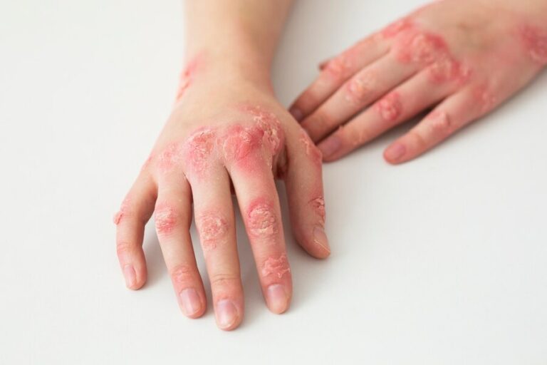 Salutequità e Apiafco: “La psoriasi entri nel Piano Nazionale Cronicità” Salutequità e Apiafco: “La psoriasi entri nel Piano Nazionale Cronicità”