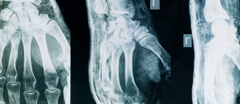 Artrite e artrosi, sintomi comuni ma cause e cure diverse