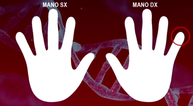 Garlasco: MDX5 fa tremare Sempio. L’impronta che ribalta tutto